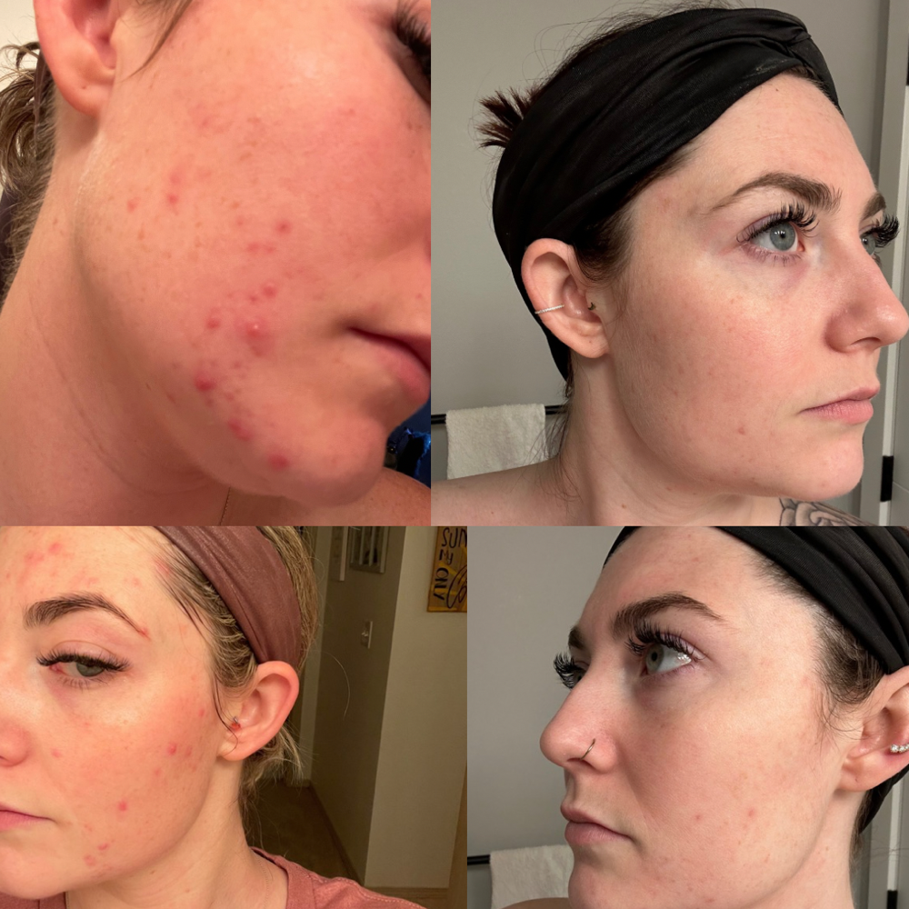 Acne Bootcamp Consultation