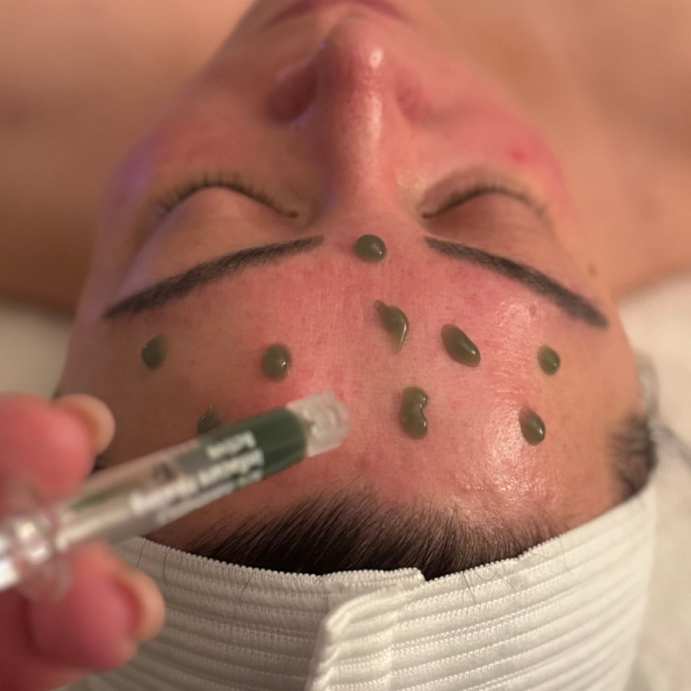 Corrective Peel at Afterglow Esthetics in Murrieta, CA