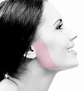 Side Burns-Laser Hair Removal