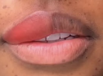 Dark Lip Correction - Rebolip at Diamond Le Brows in Yardley, PA