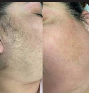 Full Face Wax