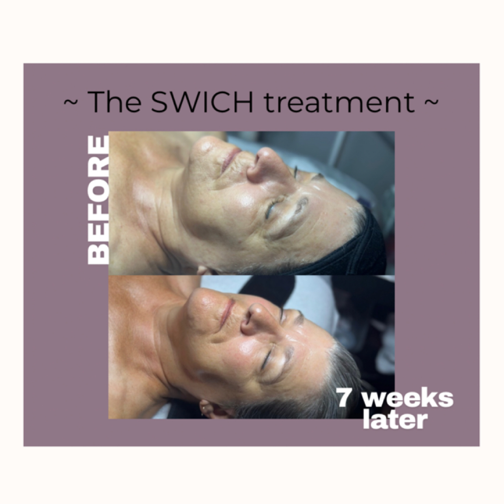 SWiCH Treatment at Faithful Skin Studio - SG in Spring Green, WI