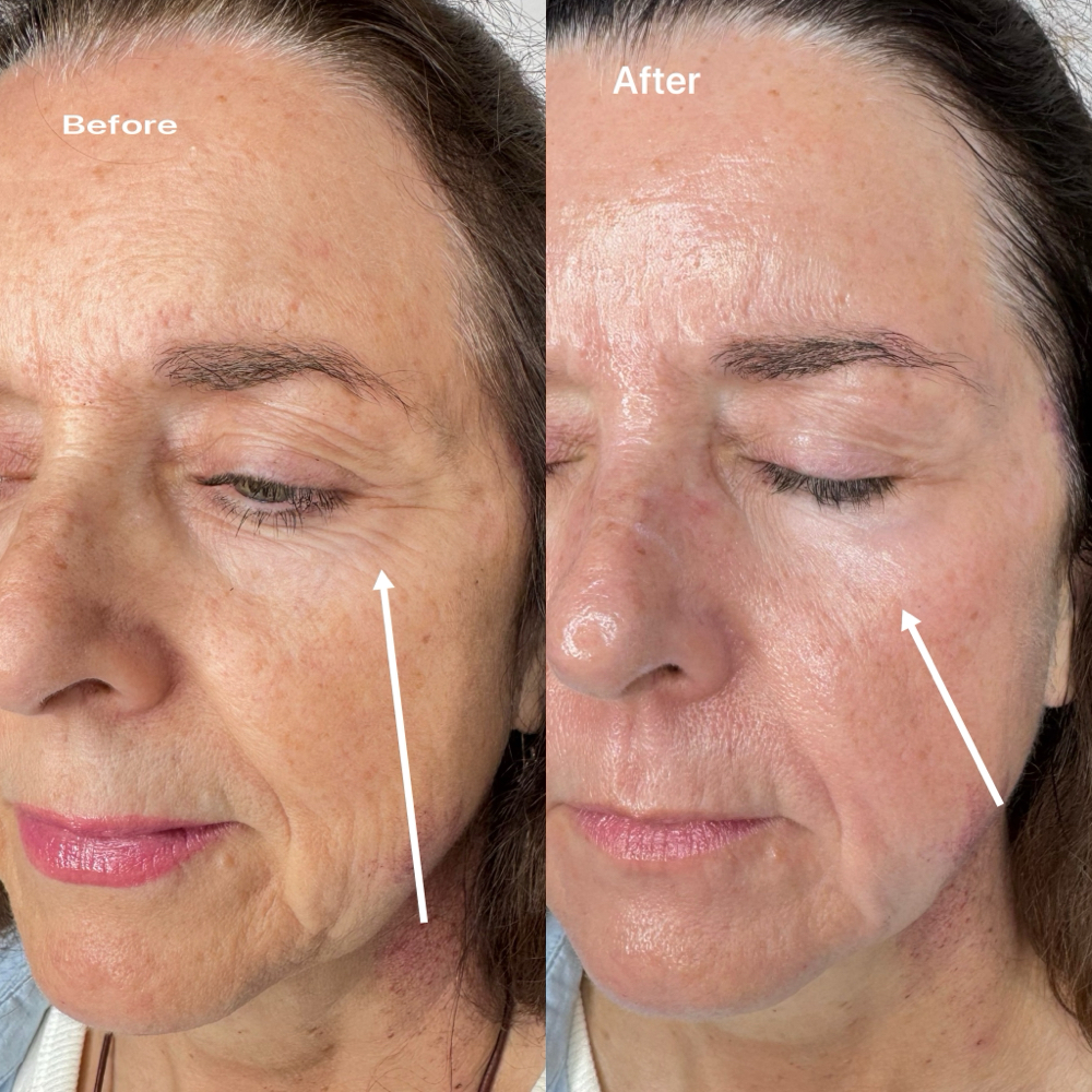 Glass Skin Hydration Facial ✨