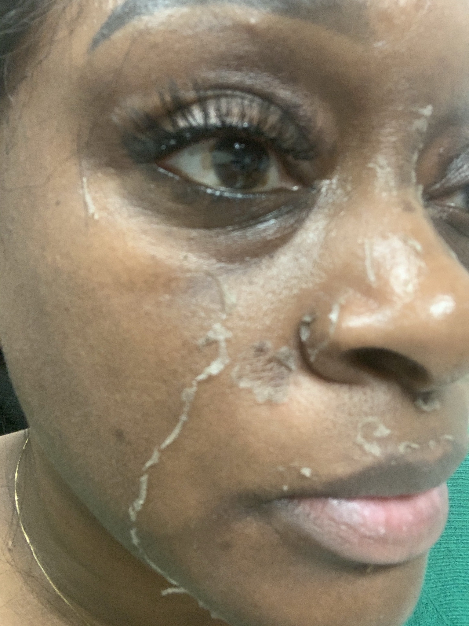 Exfoliating Peel