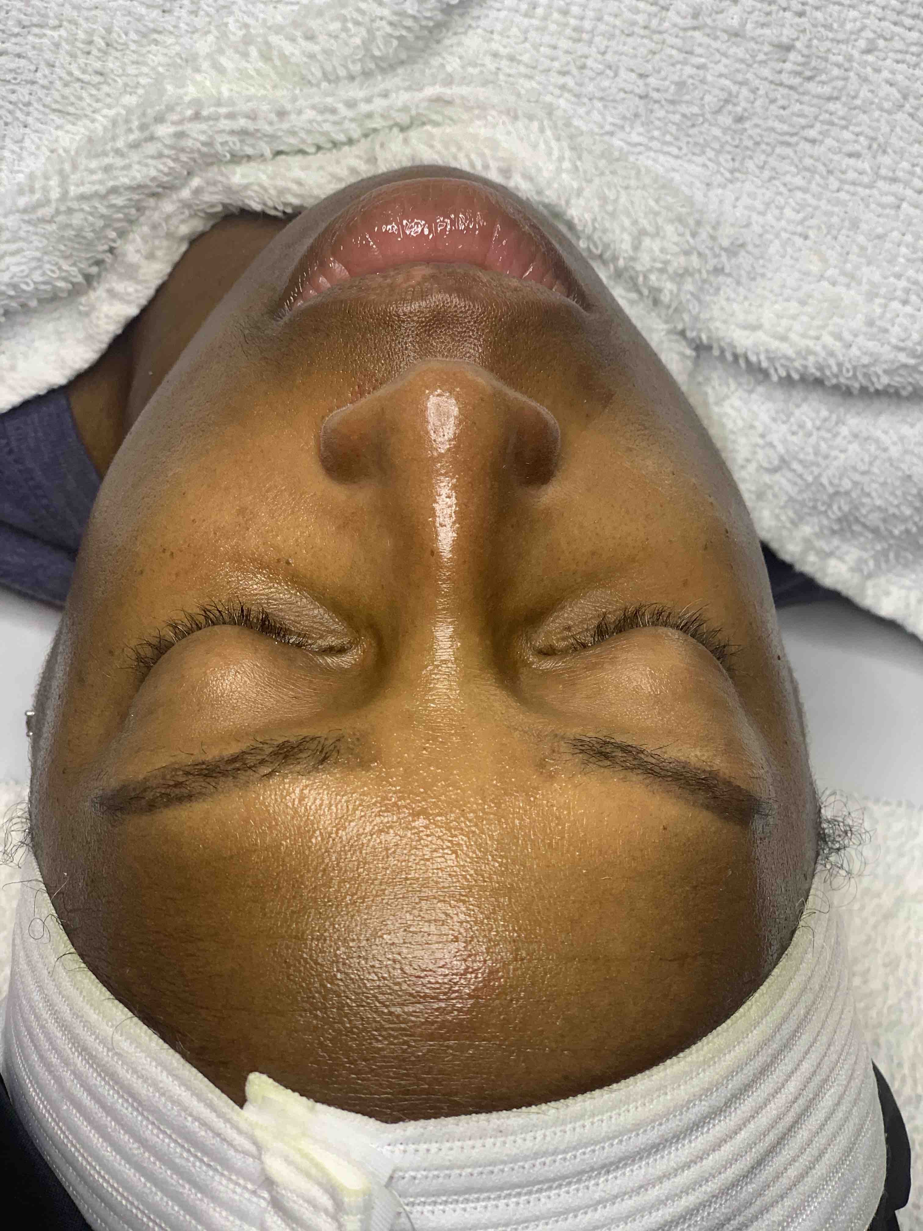Post-Peel Microdermabrasion