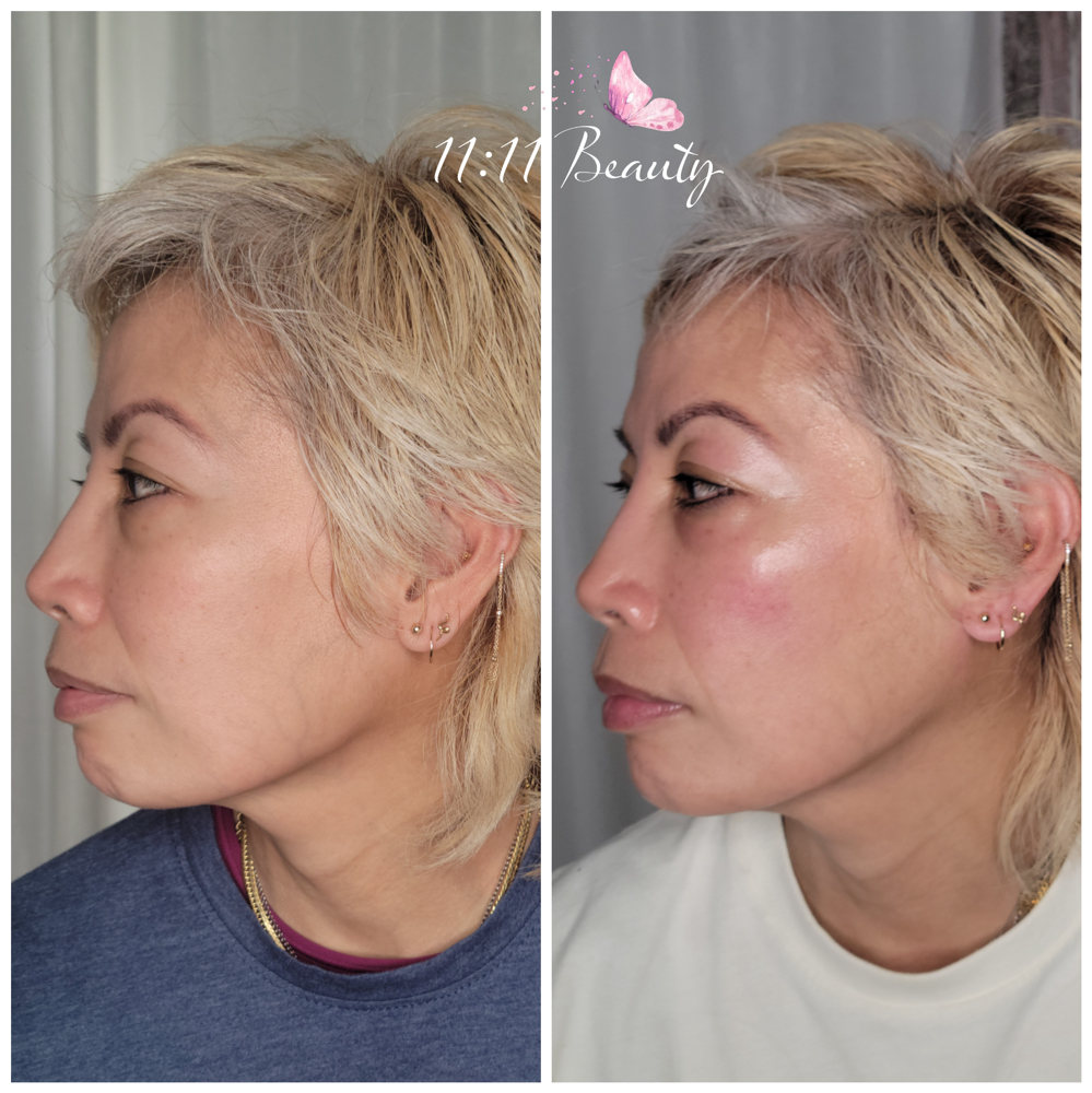 Jet Plasma Full Face 1 Session