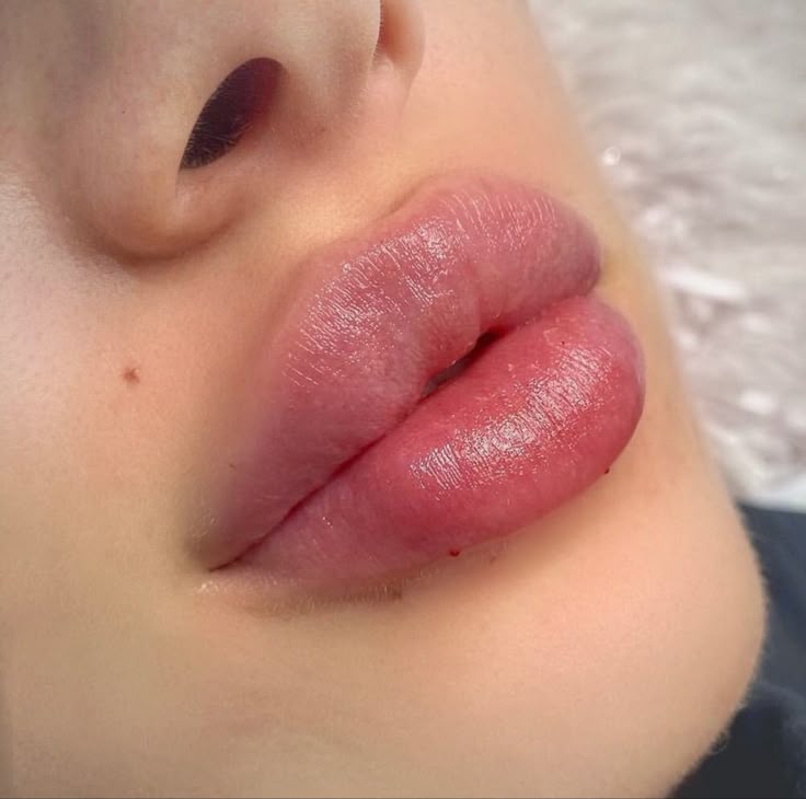 2ml Needle-less Hyaluronic Acid