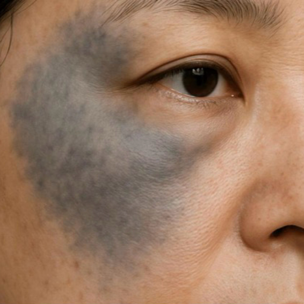 Nevus Of Ota(Consultation Required) at La Belle Studio by Soraya in Woburn, MA