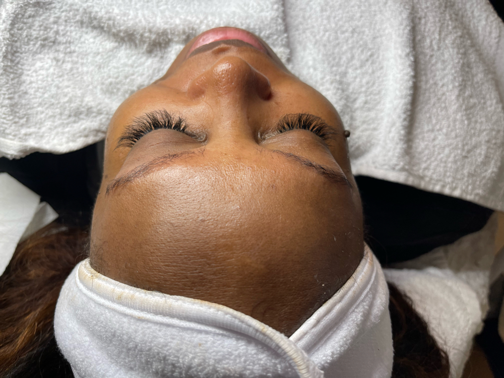 Microdermabrasion