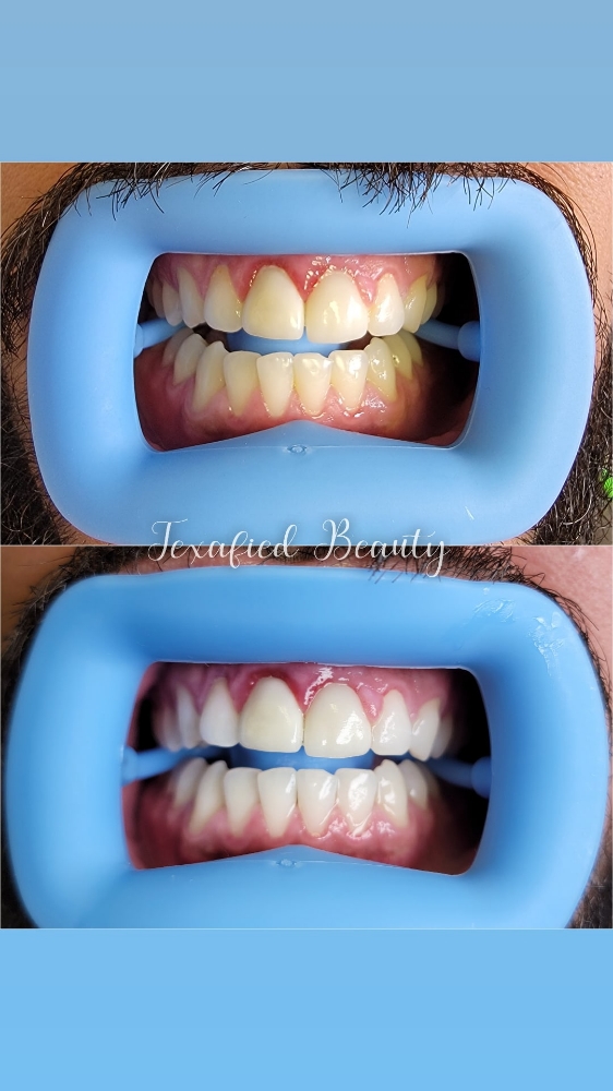 Teeth Whitening