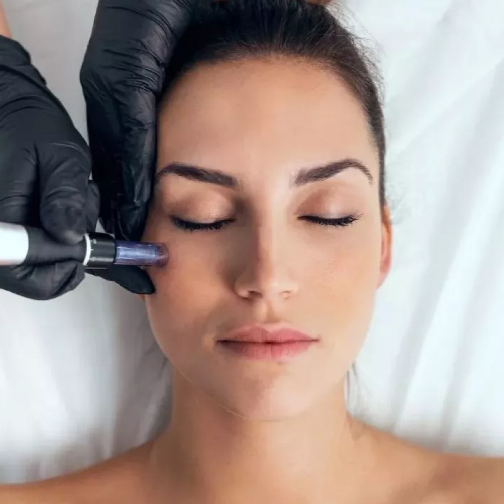 Microneedling (Face) at Skin by Cydni in Atlanta, GA