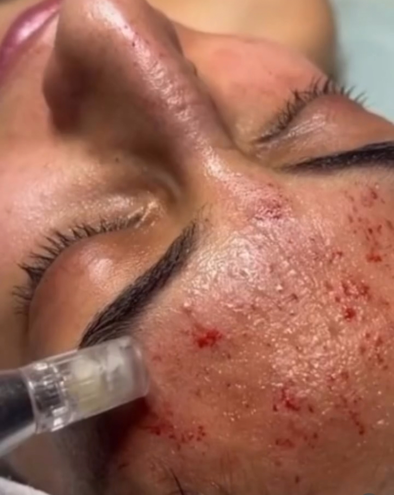 (3) Microneedling With LED Light