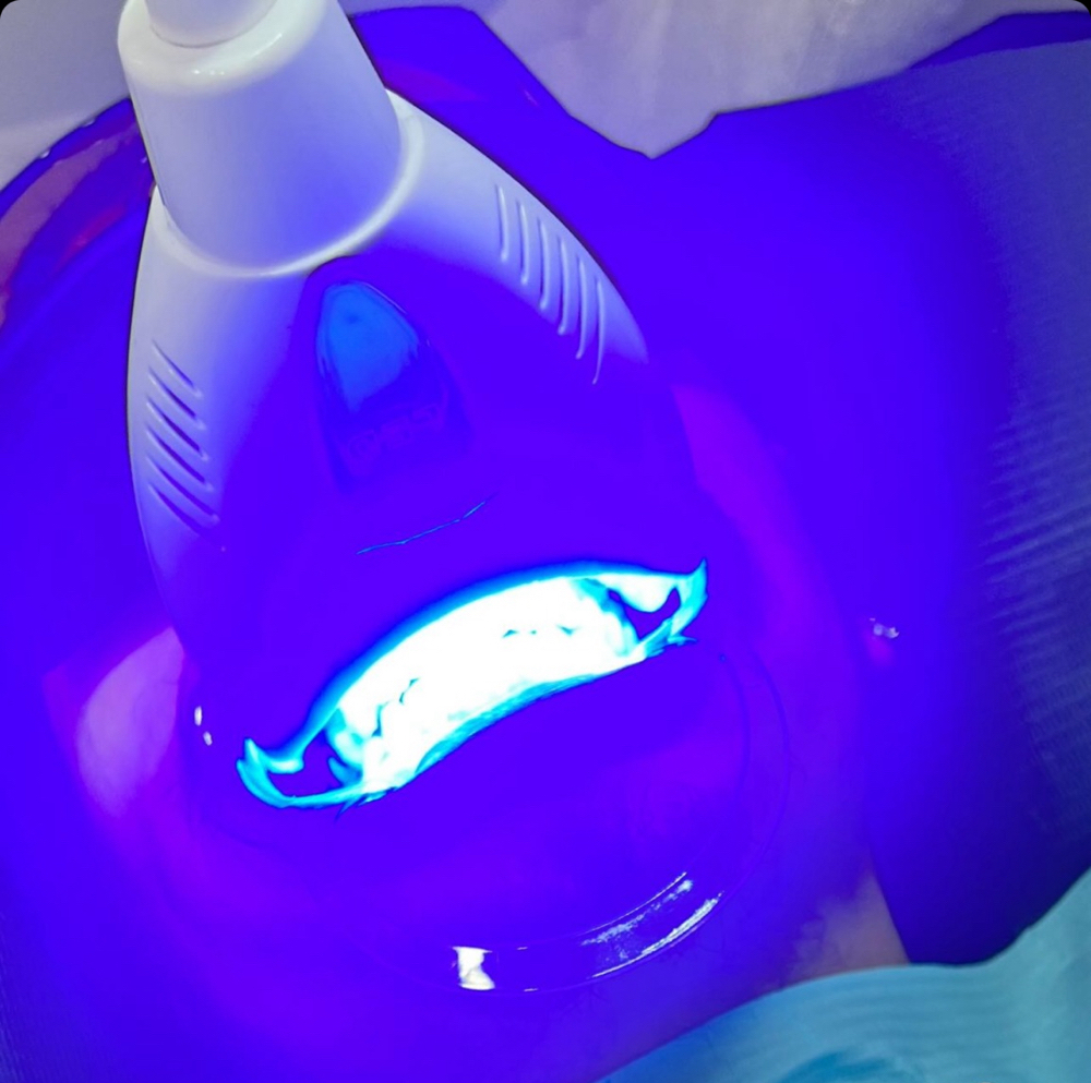Teeth Whitening (30 Mins)