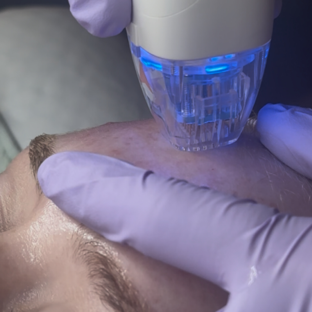 VirtueRF RF Microneedling at dermaLAB. in Auburn, AL