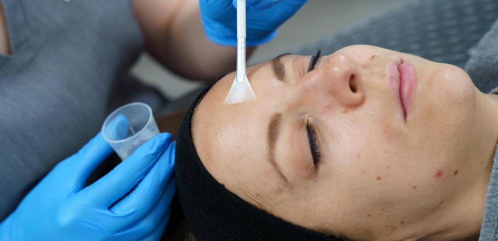 Circadia Chemical Peel