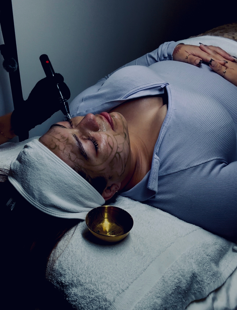 💉Nanoneedling Salmon DNA Facial