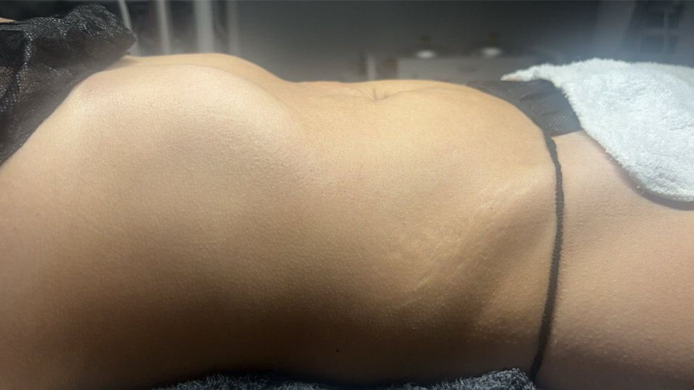 Woodtherapy Abdomen and Sides