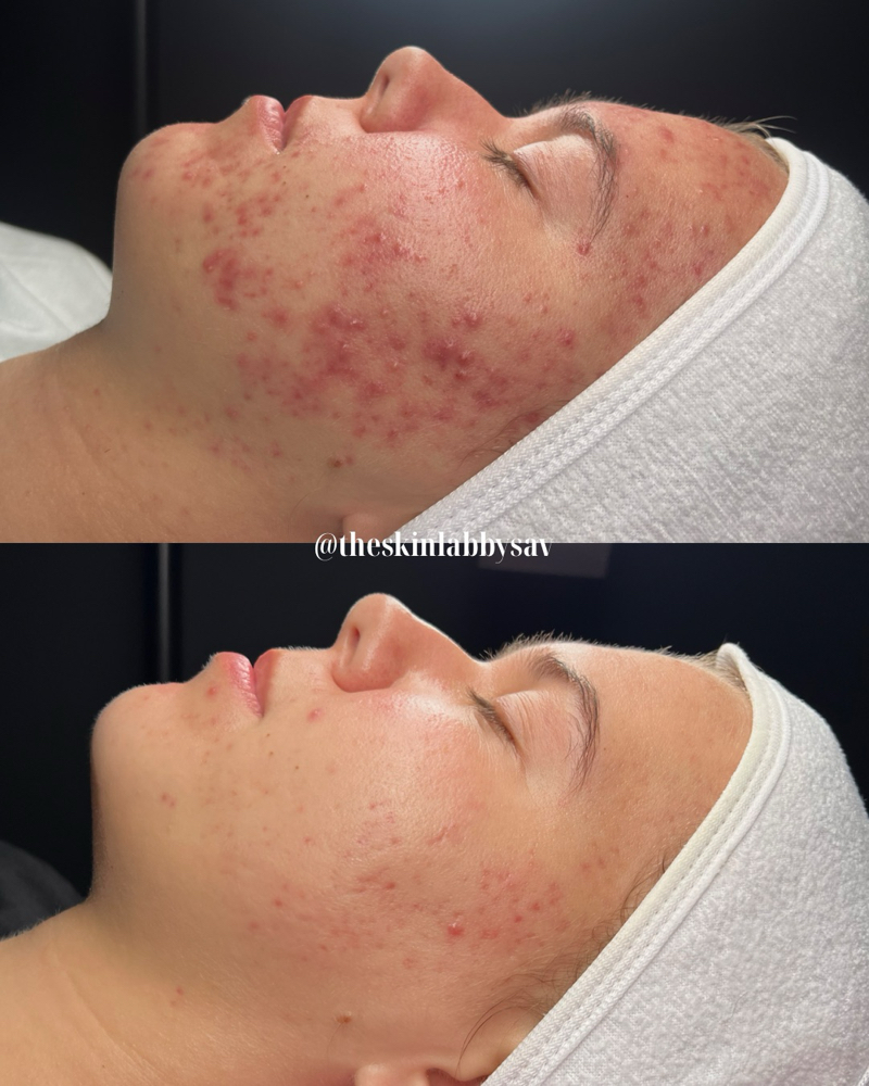 Acne Bootcamp Consultation Only