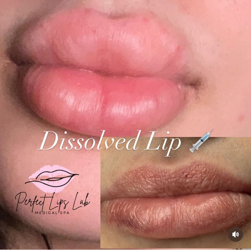 Lips Dissolved