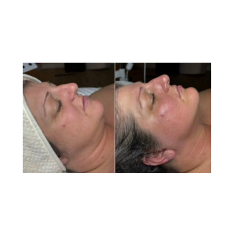 Lymphatic Drainage Massage Add-on at Softer Skin Esthetics LLC in Sedalia, MO