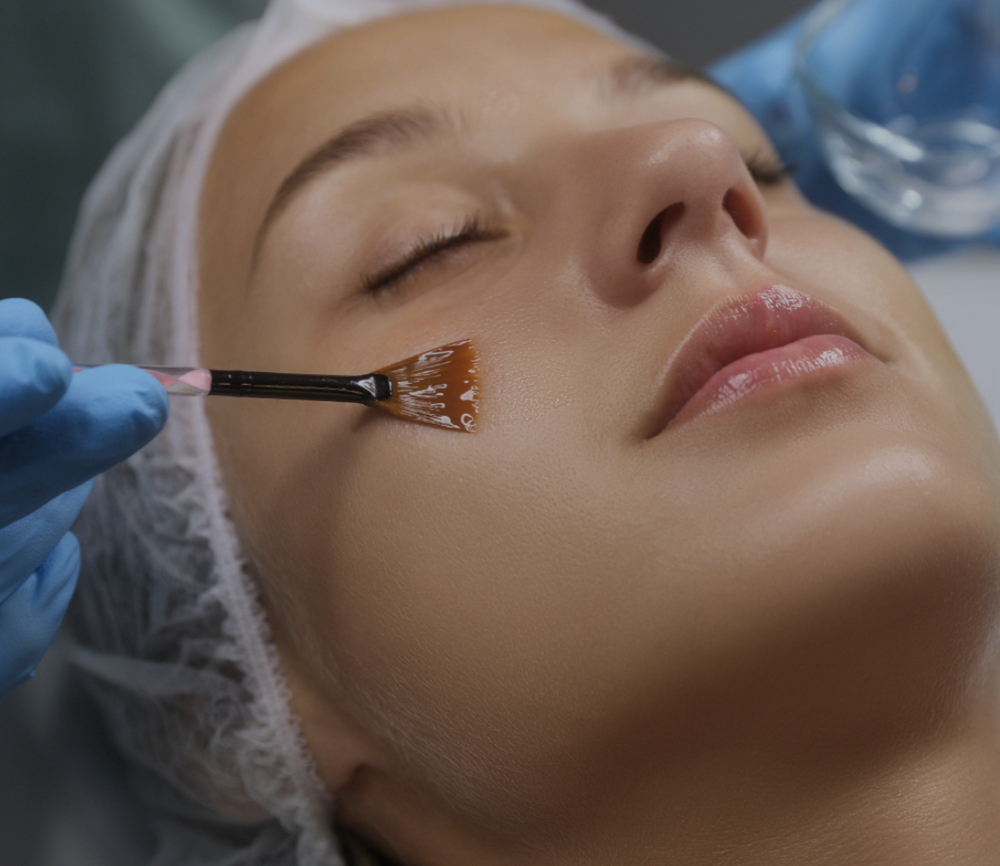 Chemical Peel