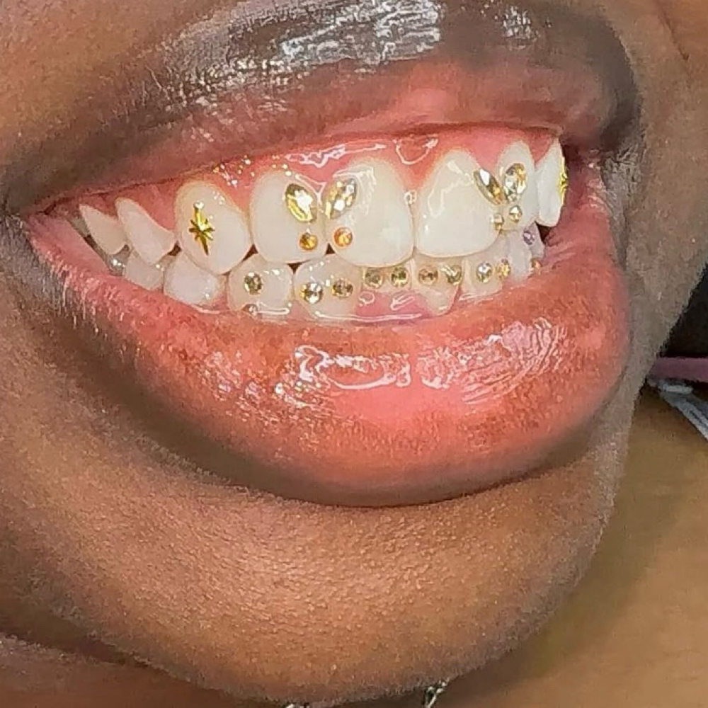 Unlimited Gems (Simple Set) at Luxe Glow Smiles in orlando, FL