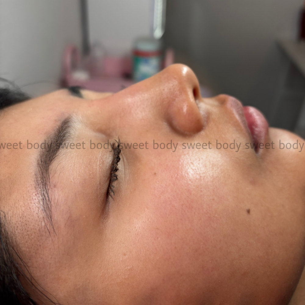 Nose Filler + Botox at SWEET BODY in San Antonio, TX