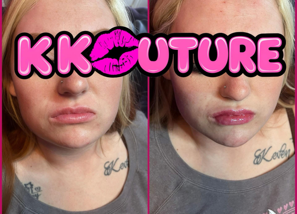 Chin Filler