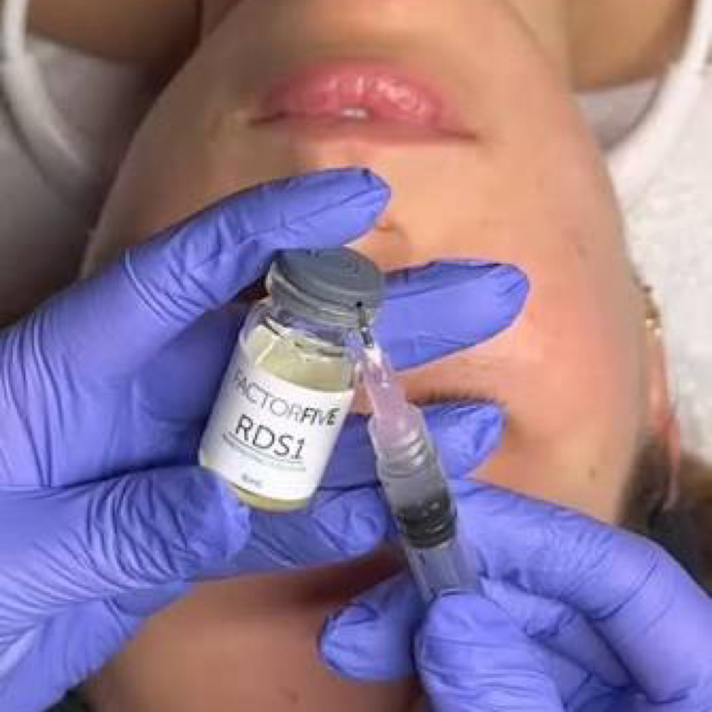 Factor 5 Stem Cell RDS Peel at SS ESTHETICS in Palmdale, CA