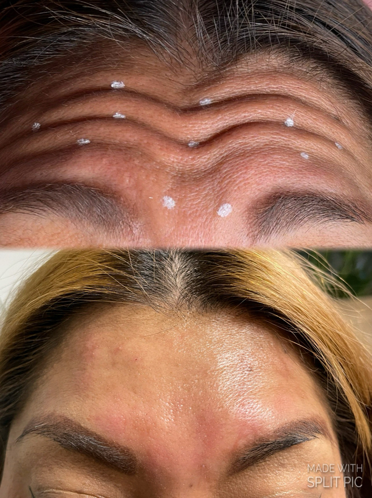 Botox Forehead $14/Unit at PuraGlow Aesthetic in Oklahoma City, OK