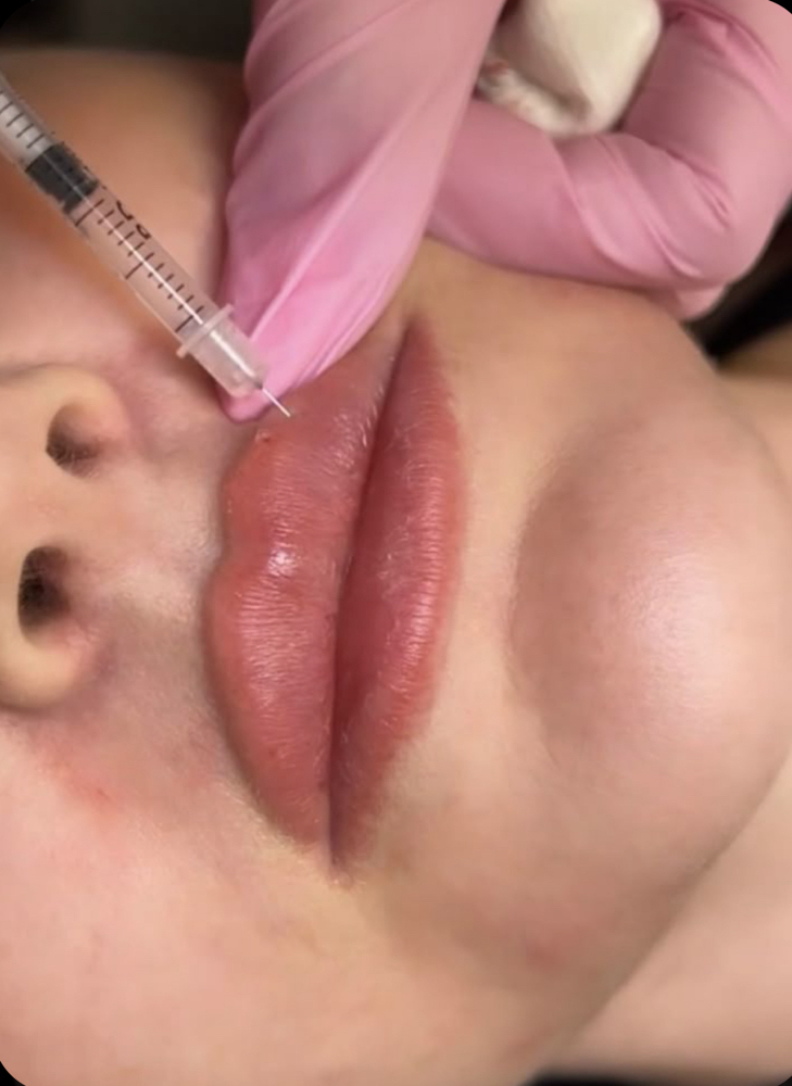 Lip Filler