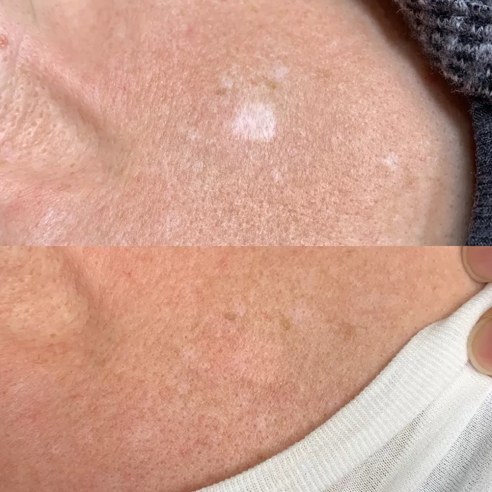 Hypopigmentation Ink Camouflage at SALCIE SKIN COMPANY in Raleigh, NC