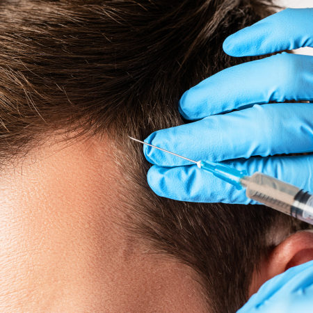 PRP Hair restoration