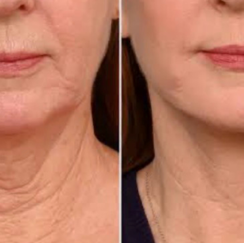 Neck Rejuvenation at Bliss Beauty Bar in Houston, TX