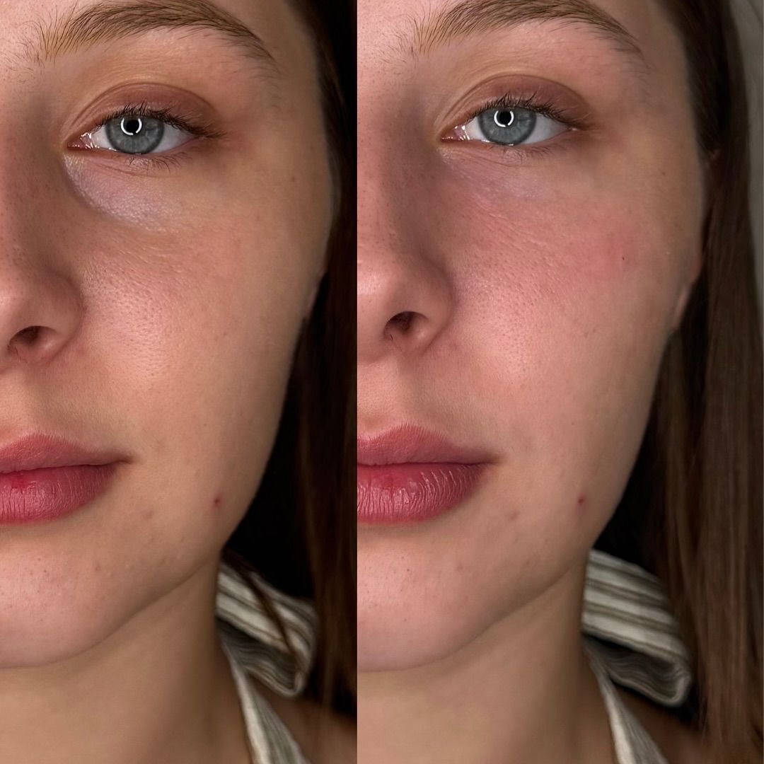 Under-eye filler at Lavana by Remake in Edinburg, TX