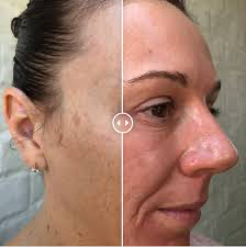 Dermaplaning With Enzyme Peel