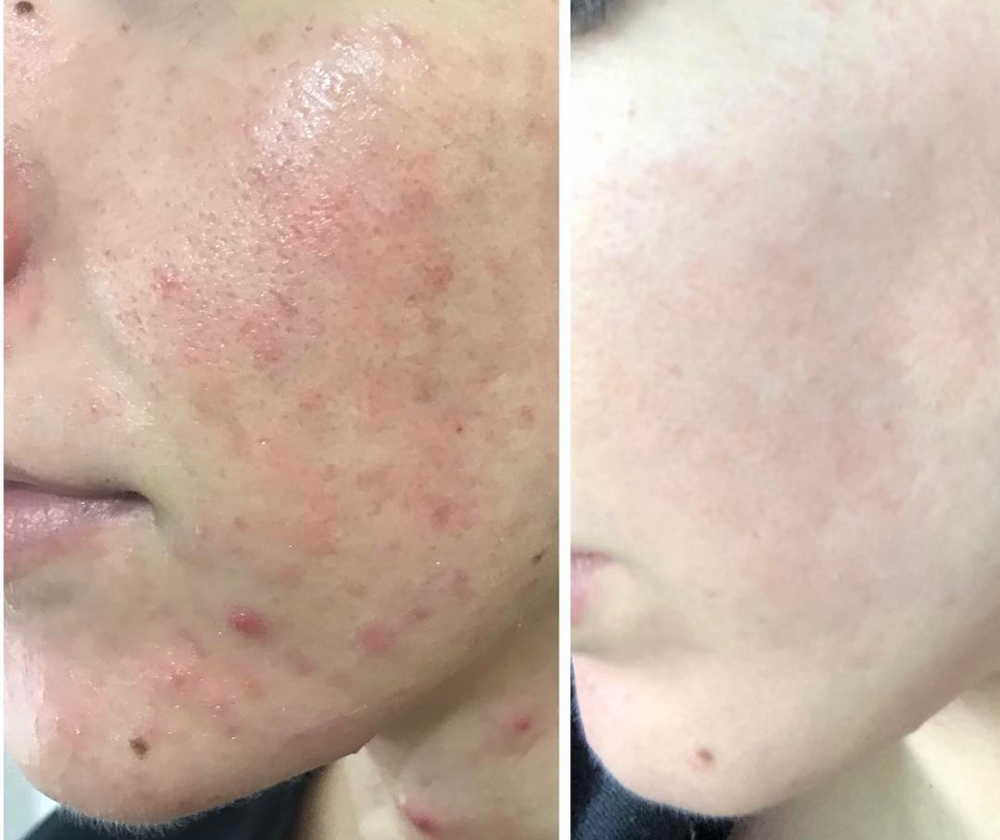 Acne Scarring