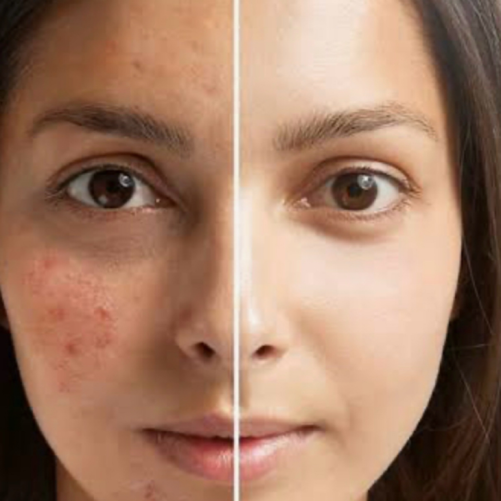 Acne Rescue Facial at Ana Aesthetic & Beauty in Freeport, NY