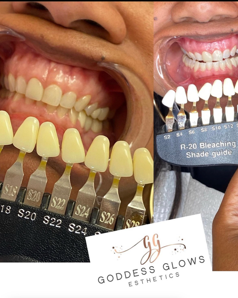 Teeth Whiting