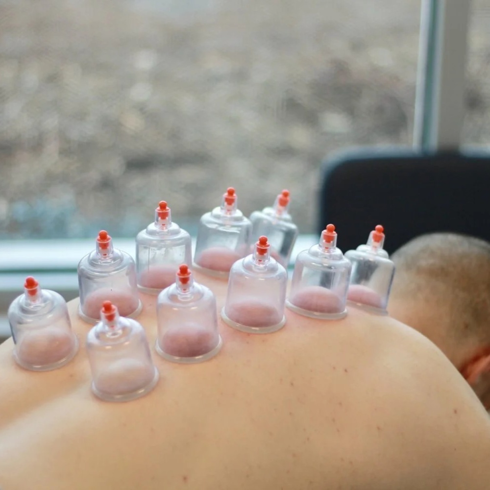 Cupping 30 mins