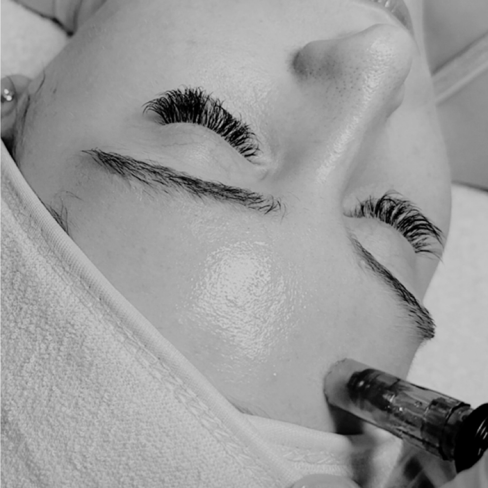 Microneedling Facial Package at Bare Aesthetics By Chloe in Lake Norman of Catawba, NC