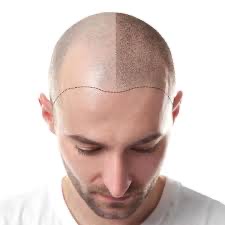 Scalp Micro Pigmentation