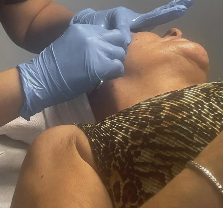 Dermaplaning