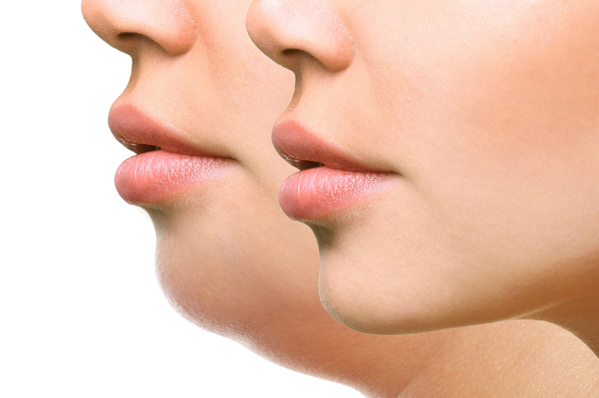 RF Facial & Chin Blaster