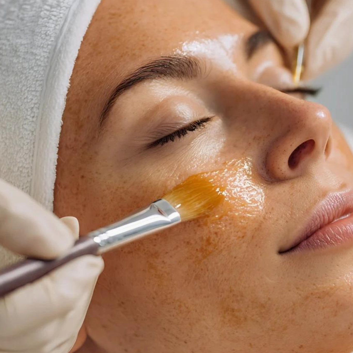 Pigment Correcting Peel at Aesthetics by Aunnie in Costa Mesa, CA