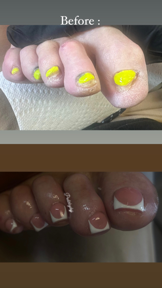 Toe BBL ( reconstruction )