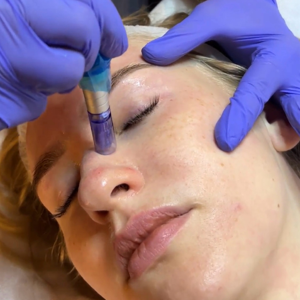 Microneedling