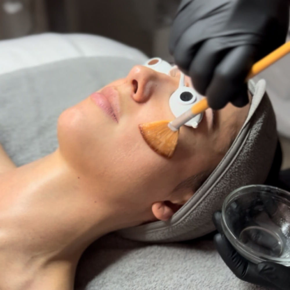 Chemical Exfoliant/Peel at The Skin Co. in Orange, CA
