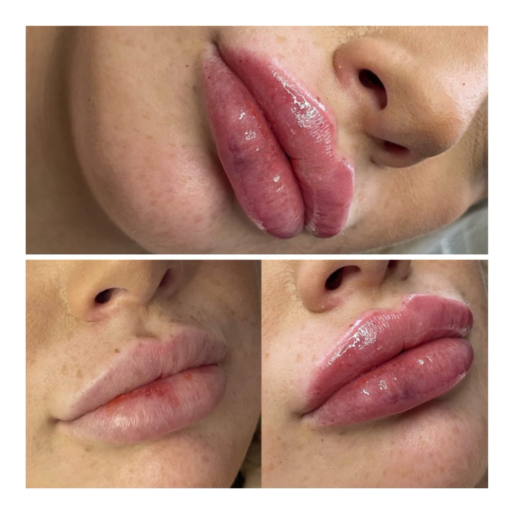 .05 Lip Filler🫦 at Barbie Aesthetics 💋 in Springfield, MA