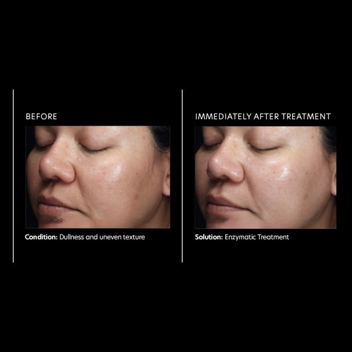 Enzymatic Treatmemt